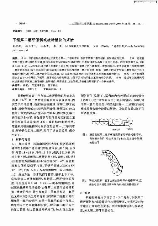 下颌第二磨牙倾斜或旋转错位的矫治