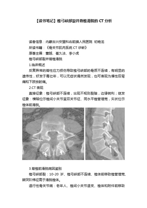 【读书笔记】椎弓峡部裂并脊椎滑脱的CT分析