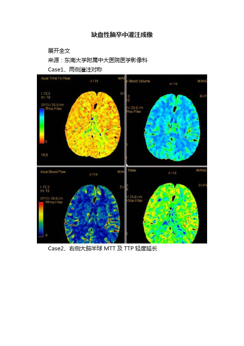 缺血性脑卒中灌注成像