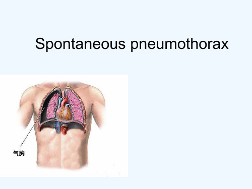气胸病例报告