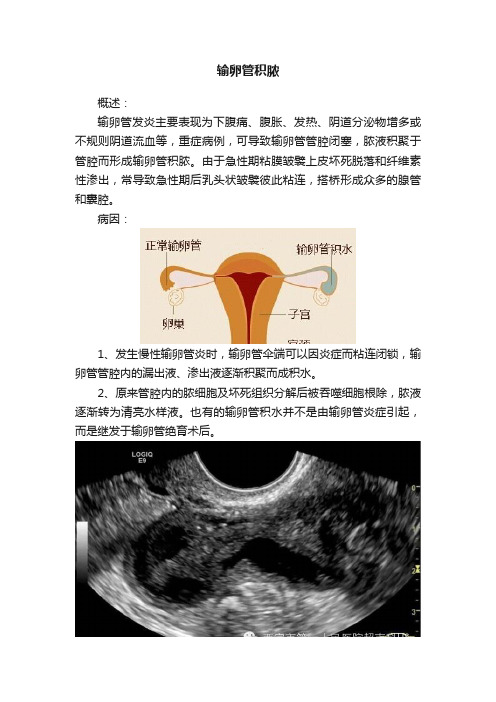 输卵管积脓