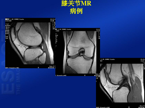 膝关节MR病例参考PPT