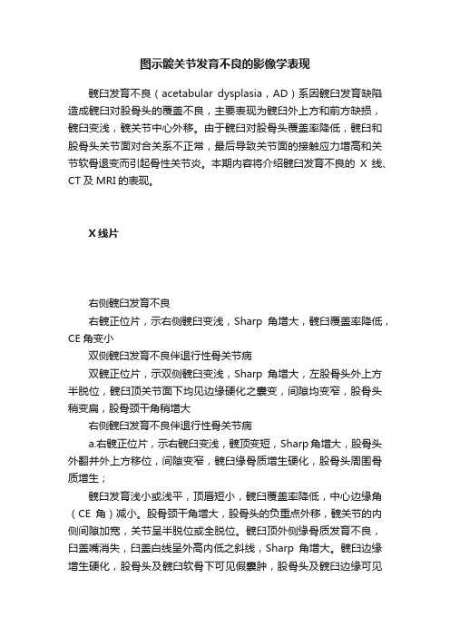 图示髋关节发育不良的影像学表现