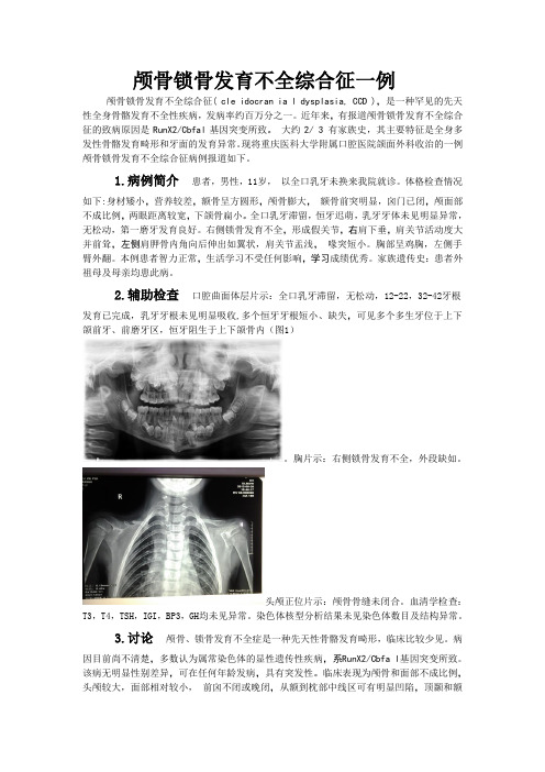 颅骨锁骨发育不全综合征一例