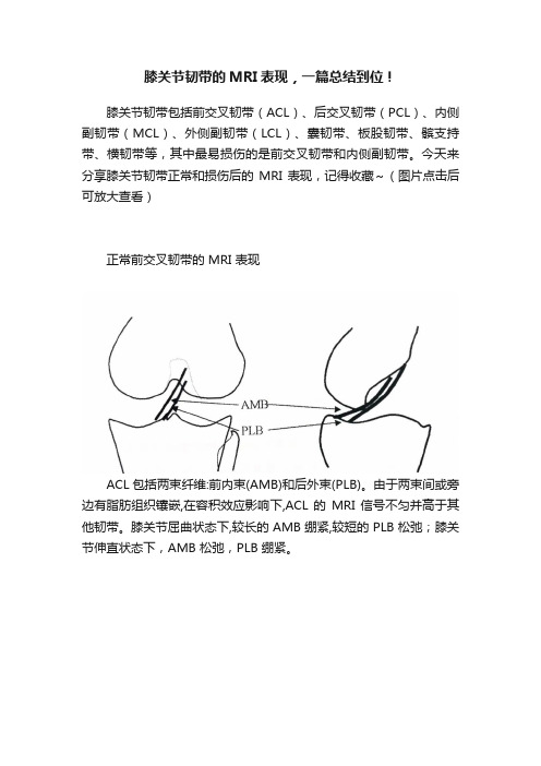 膝关节韧带的MRI表现，一篇总结到位！