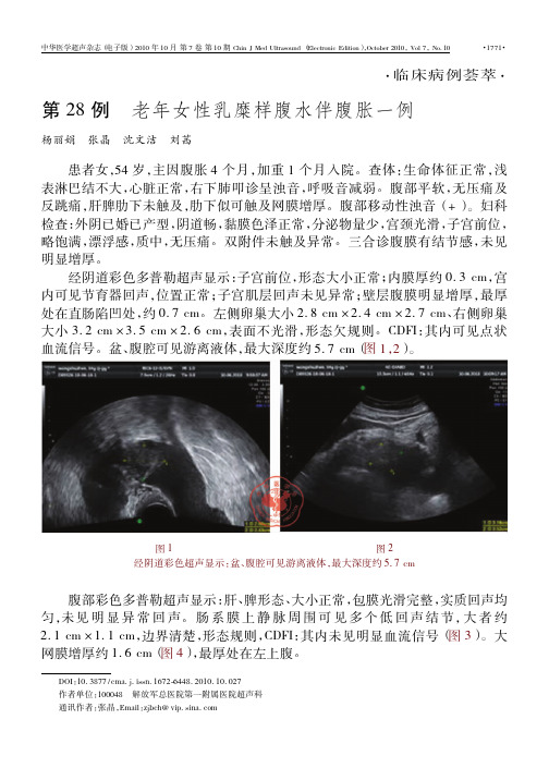 第28例老年女性乳糜样腹水伴腹胀一例