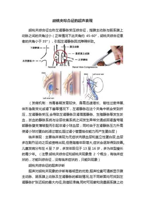 胡桃夹综合征的超声表现