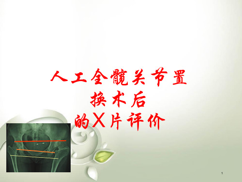 一文看懂全髋关节置换术后的X线评价精品PPT课件
