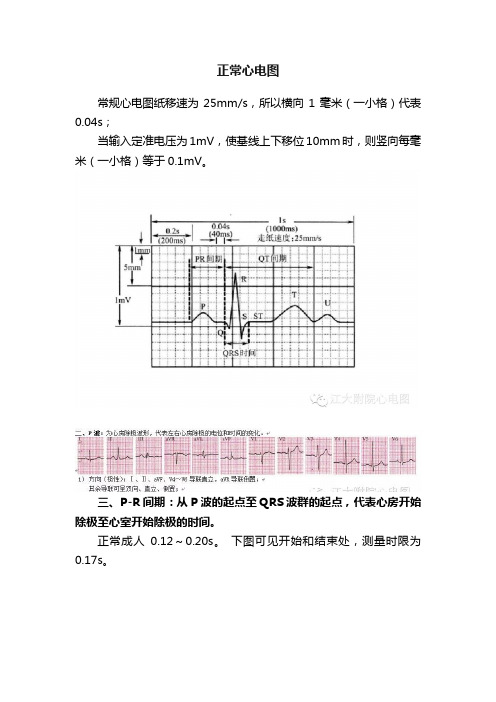 正常心电图