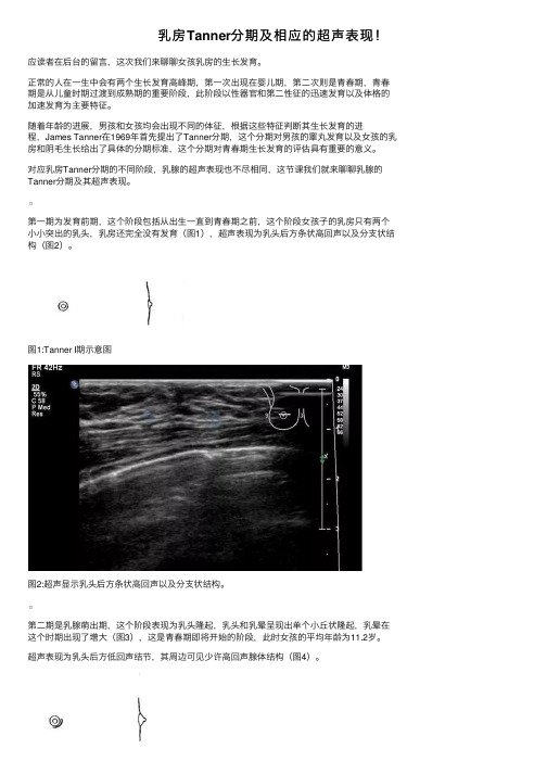 乳房Tanner分期及相应的超声表现！