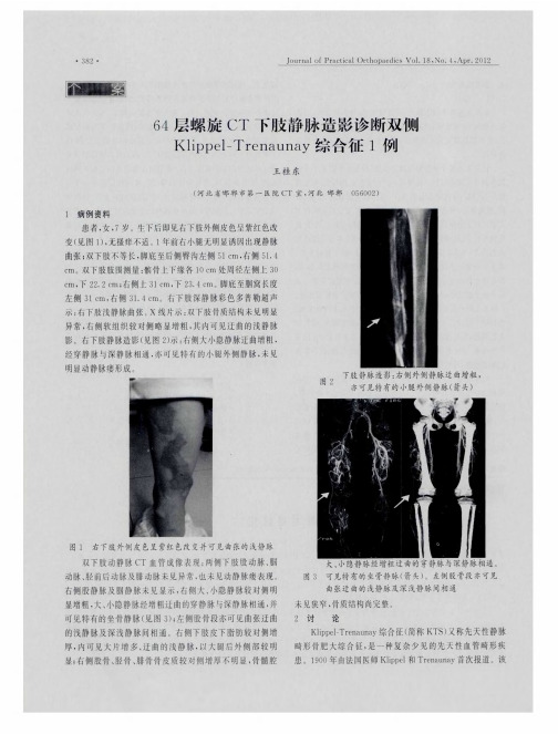 64层螺旋CT下肢静脉造影诊断双侧Klippel-Trenaunay综合征1例