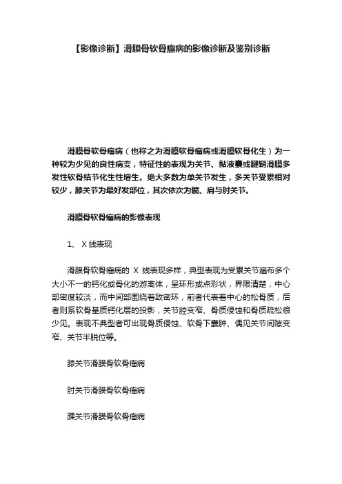 【影像诊断】滑膜骨软骨瘤病的影像诊断及鉴别诊断