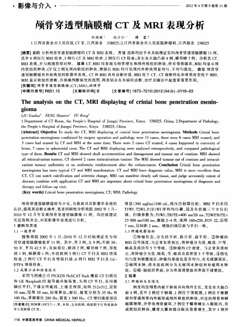 颅骨穿透型脑膜瘤CT及MRI表现分析