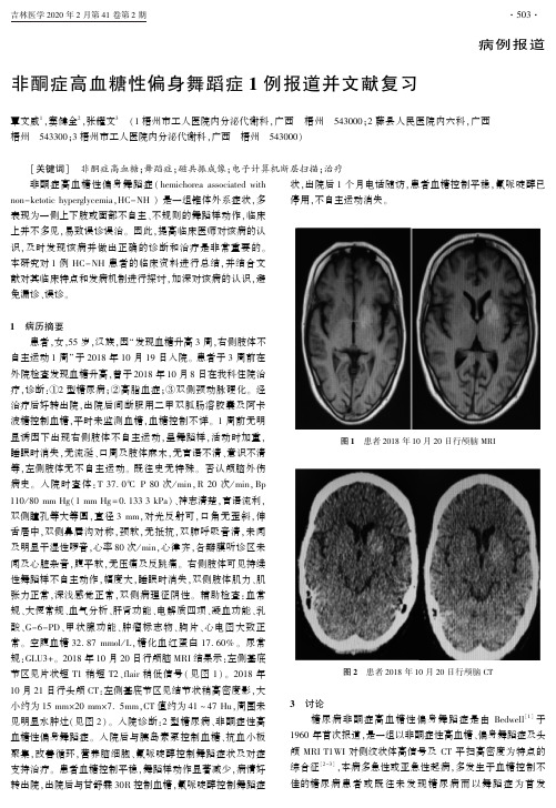 非酮症高血糖性偏身舞蹈症1例报道并文献复习