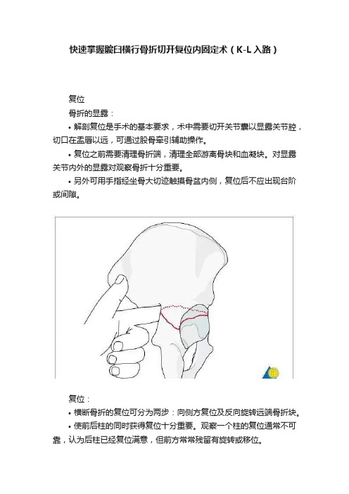 快速掌握髋臼横行骨折切开复位内固定术（K-L入路）