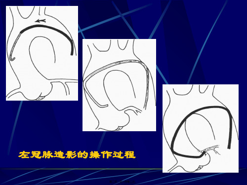 冠脉造影术简装板绝好资料