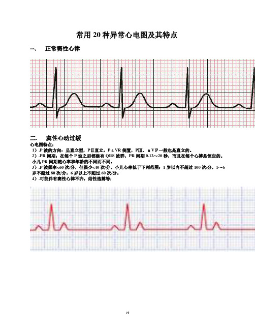 常用20种异常心电图及其特点