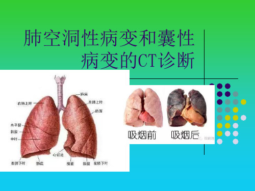 肺空洞性病变和囊性病变的CT诊断PPT幻灯片