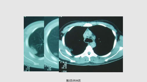 肺栓塞的诊疗