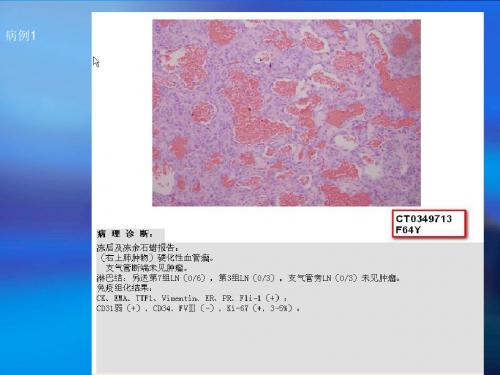 2018年肺部错构瘤ct鉴别诊断病例随访-精品文档