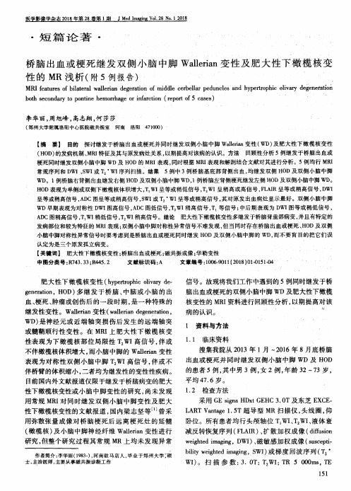 桥脑出血或梗死继发双侧小脑中脚Wallerian变性及肥大性下橄榄核变性的MR浅析(附5例报告)