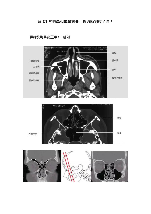 从CT片看鼻和鼻窦病变，你诊断到位了吗？