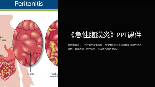 《急性腹膜炎》课件