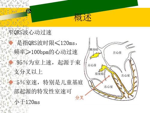 窄QRS心动过速的心电图定位诊断