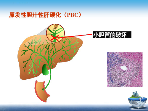 原发性胆汁性肝硬化诊治共识解读ppt课件