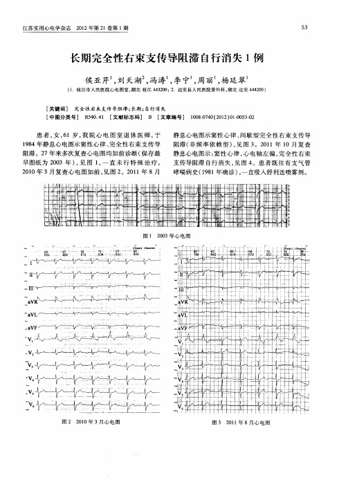 长期完全性右束支传导阻滞自行消失1例