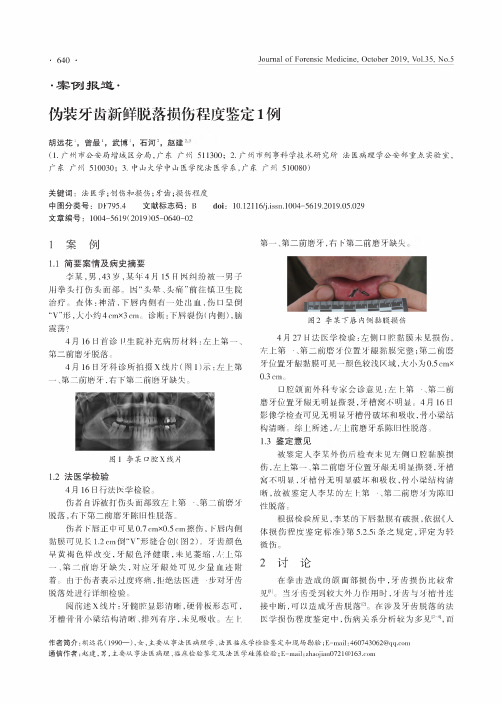 伪装牙齿新鲜脱落损伤程度鉴定1例