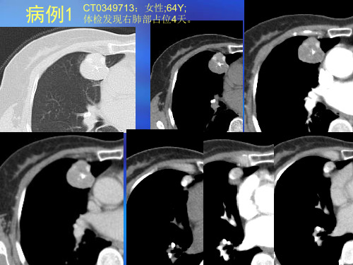“肺部错构瘤ct鉴别诊断病例随访”