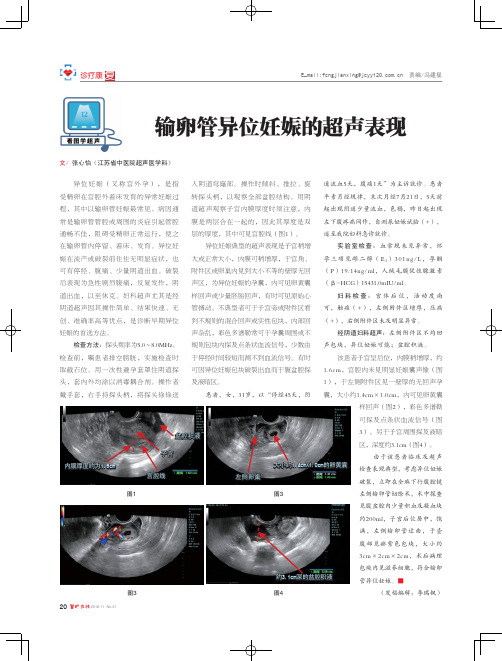 输卵管异位妊娠的超声表现