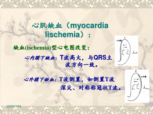 心肌缺血心电图 ppt课件