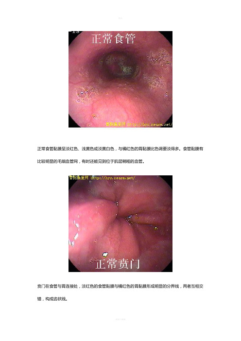 胃镜图片