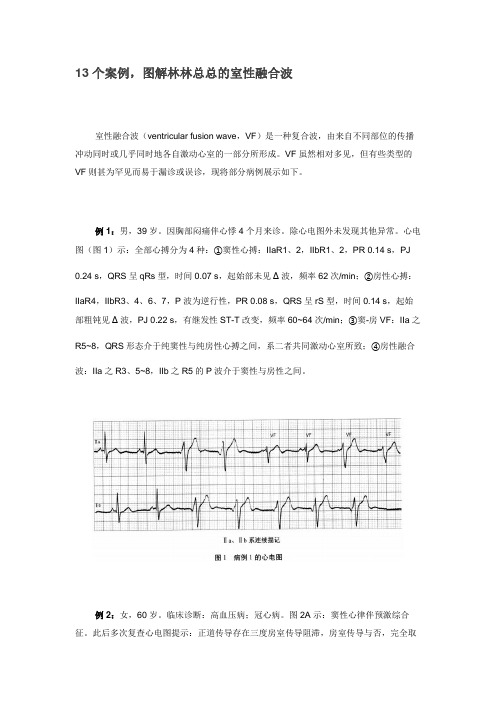 13个案例,图解林林总总的室性融合波