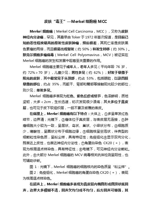 皮肤“毒王”—Merkel细胞癌MCC