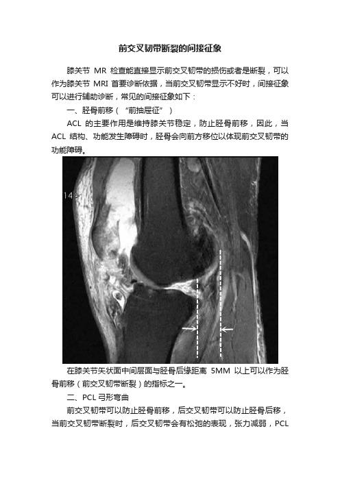 前交叉韧带断裂的间接征象