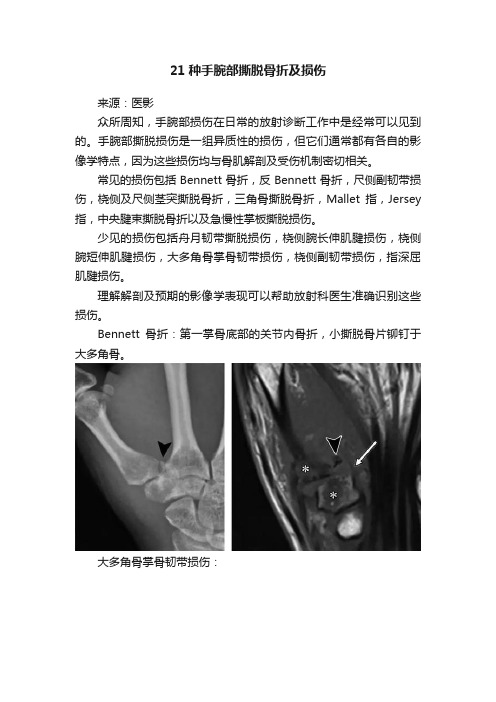 21种手腕部撕脱骨折及损伤