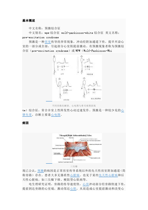 预激综合症