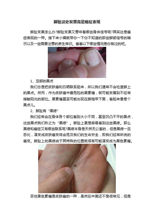 脚趾这处发黑竟是癌症表现