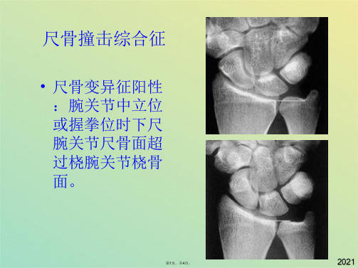 腕关节损伤mr征象(共4张PPT)