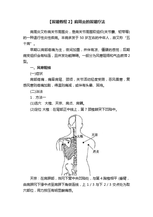 【拔罐教程2】肩周炎的拔罐疗法