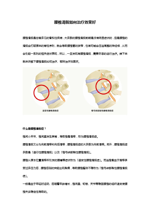 腰椎滑脱如何治疗效果好