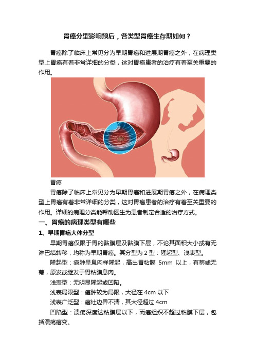 胃癌分型影响预后，各类型胃癌生存期如何？