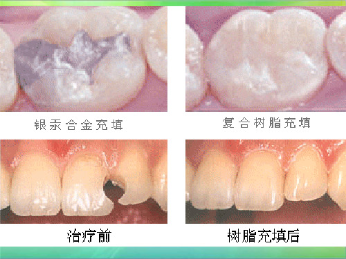 树脂充填PPT课件