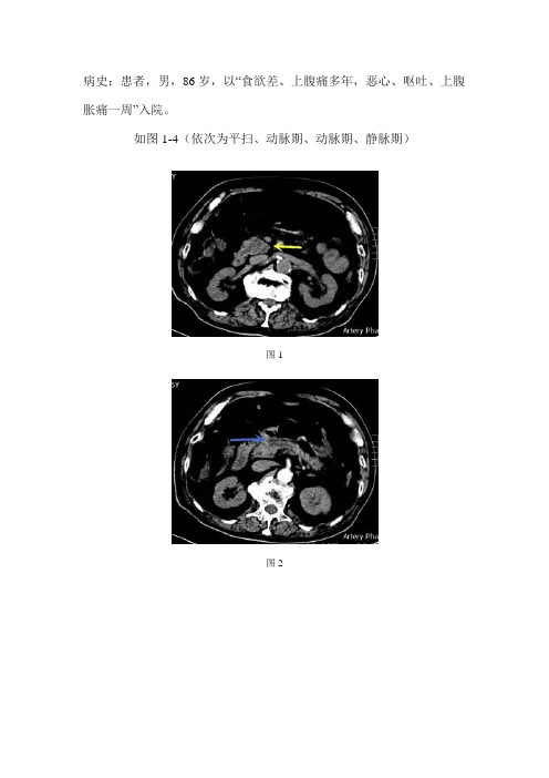 胰头葡萄状囊性占位与胰管相通病变--导管内乳头状粘液瘤