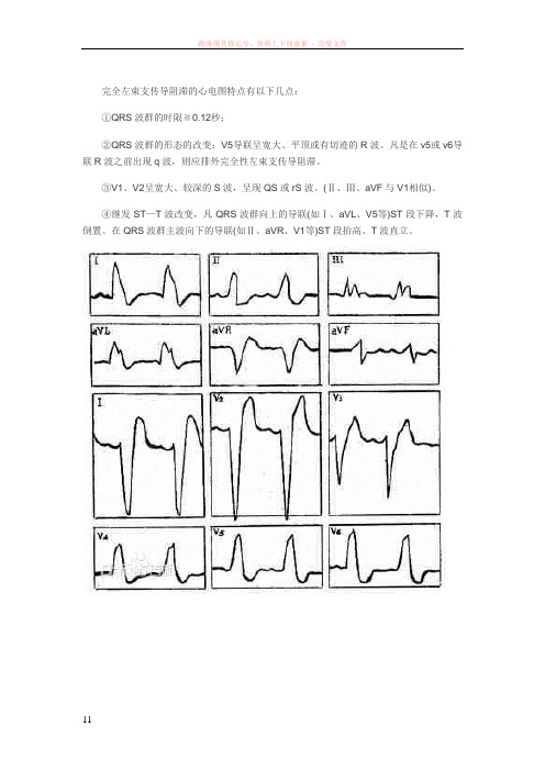 完全左束支传导阻滞与完全右束支传导阻滞心电图特点