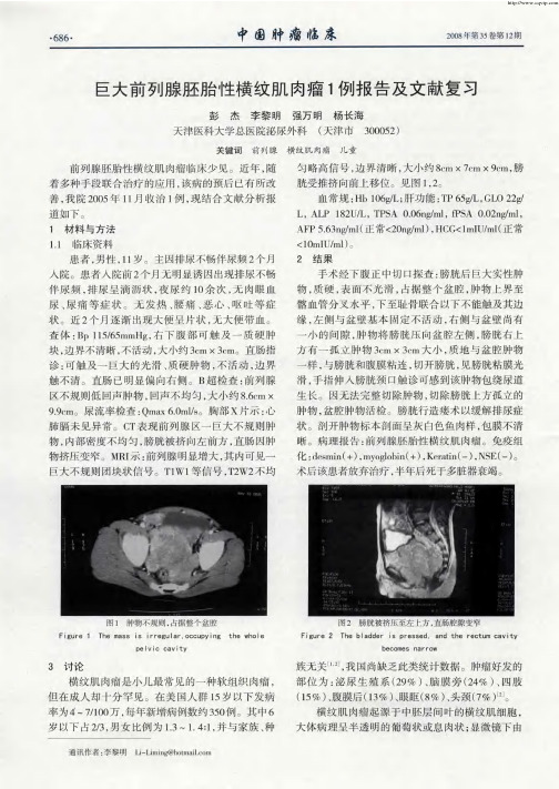 巨大前列腺胚胎性横纹肌肉瘤1例报告及文献复习