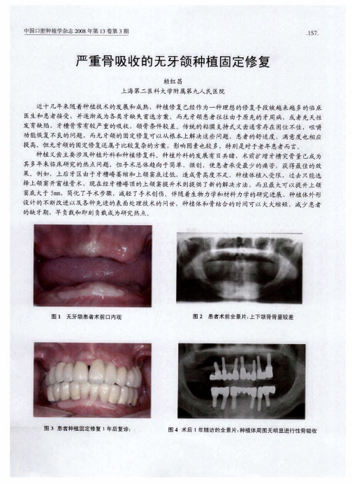 严重骨吸收的无牙颌种植固定修复